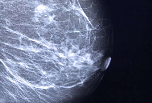 mammograms' of breast with cancer